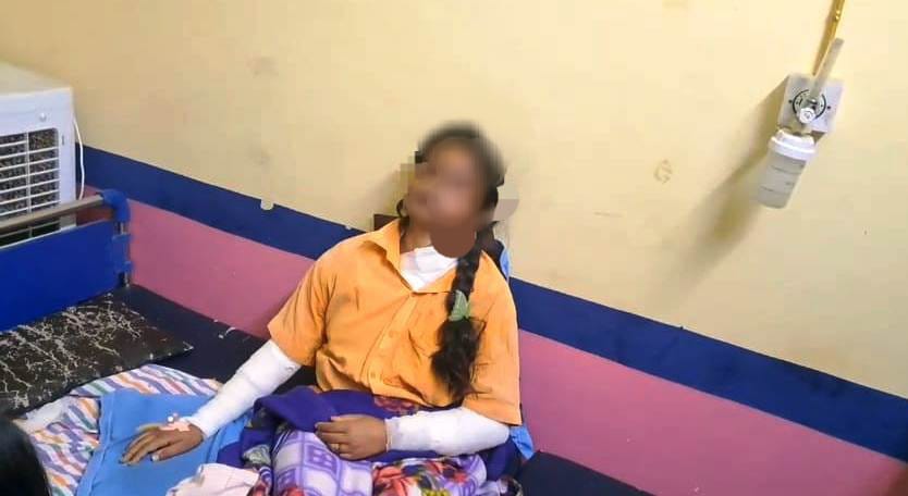 बेगूसराय में अपराधियों ने सोये अवस्था में एक लड़की के चहरे पर फेका एसिड, लड़की बुरी तरह झुलसकर घायल 3