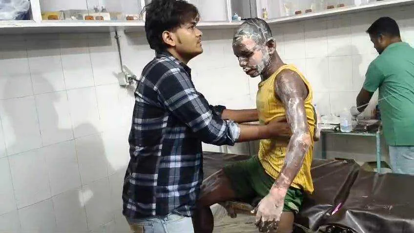 बेगूसराय मे चाय बनाने के दौरान गैस की लपते से एक युवक झुलसा, सदर अस्पताल में भर्ती   5