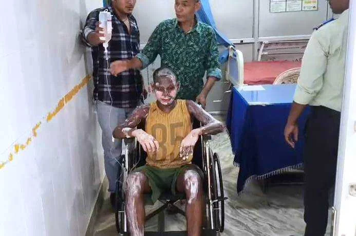 बेगूसराय मे चाय बनाने के दौरान गैस की लपते से एक युवक झुलसा, सदर अस्पताल में भर्ती   2