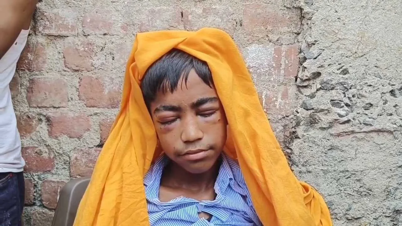 नालंदा: बच्चों के बीच खेलने के विवाद में चचेरी भाभी ने अपने ही देवर की दोनों आँखें फोड़ी, बच्चे की हालत गंभीर, दोनों पक्षों से सात लोग नामजद 2